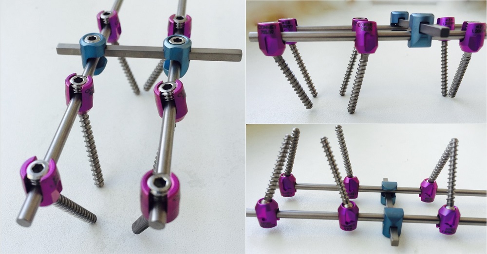 Транспедикулярная фиксация позвоночника