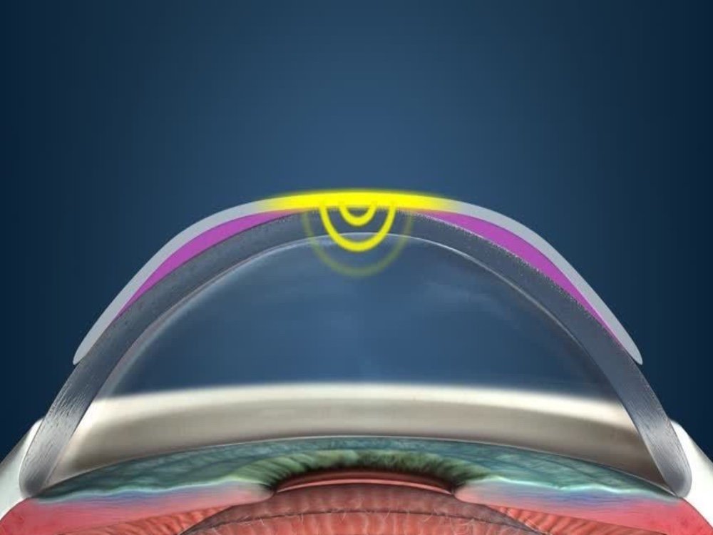 Ок линзы - жесткие ночные линзы для восстановления зрения у детей