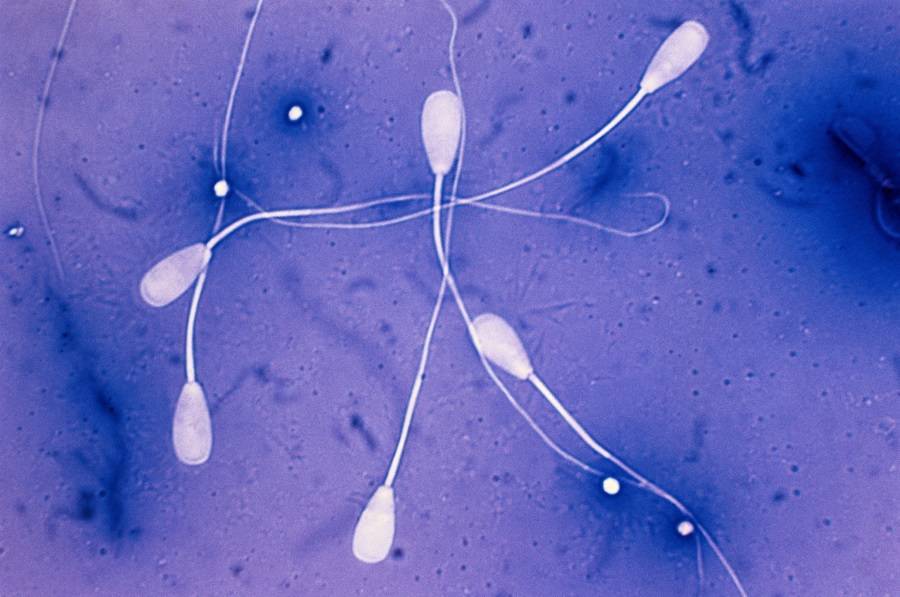 Агглютинация сперматозоидов, виды и симптомы
