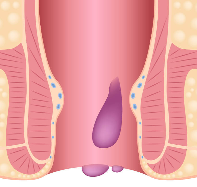 Почему необходимо своевременно лечить геморрой