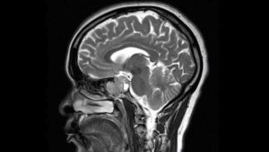 Что такое гипофиз, и почему так важно сделать его МРТ?