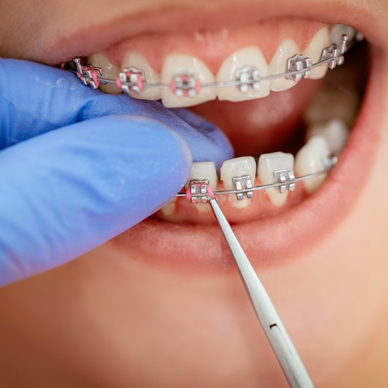 Своевременные брекеты: Путь к здоровой улыбке