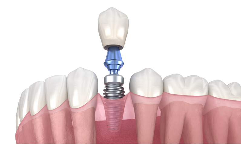 Имплантация зубов в Сургуте - новый уровень стоматологии