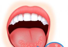 Что такое стоматит и как его лечить