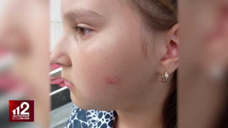 Мужчина потушил сигарету о щеку школьницы в Екатеринбурге