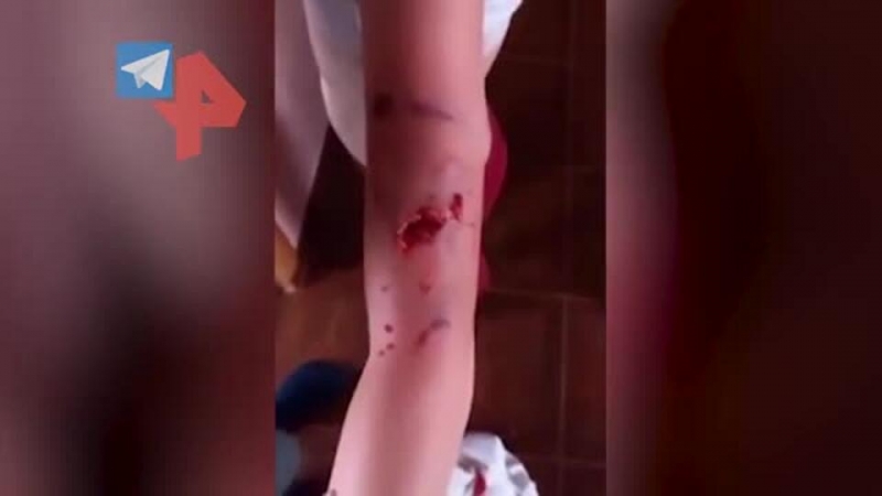 Бродячие собаки искусали школьницу в Липецкой области