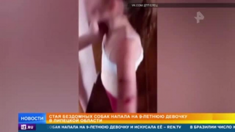 Бродячие собаки искусали школьницу в Липецкой области