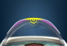 Ок линзы — жесткие ночные линзы для восстановления зрения у детей