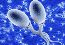 Агглютинация сперматозоидов, виды и симптомы