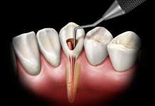 Как проходит лечение корневых каналов