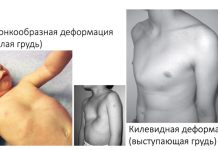 Патологии грудной клетки у детей