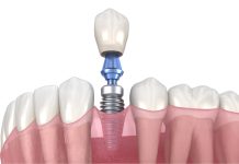Имплантация зубов в Сургуте — новый уровень стоматологии