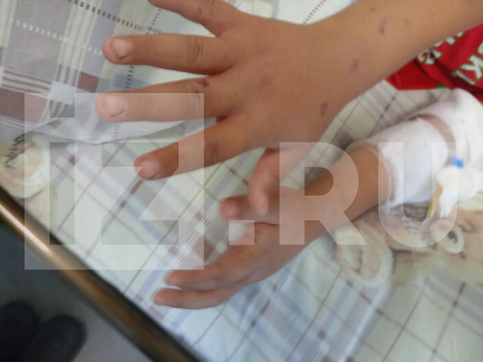 Маленькие братья из Башкирии рассказали, как пчелы ужалили их 465 раз