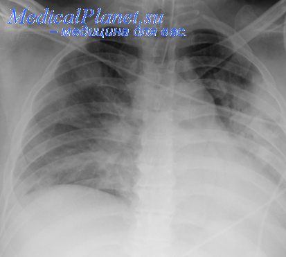 Препараты и методы их применения при иммунотерапии аллергических заболеваний Препараты и методы их применения при иммунотерапии аллергических заболеваний