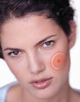 Угри на лице Угри на лице