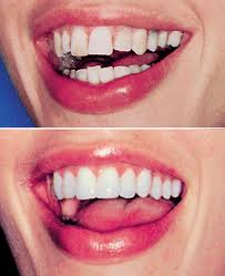 Винир для красивой улыбки Винир для красивой улыбки