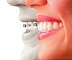 Польза брекетов Польза брекетов