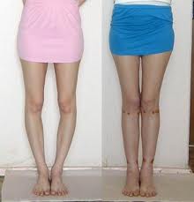 Исправление кривизны ног Исправление кривизны ног