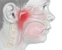 Аденоиды Аденоиды