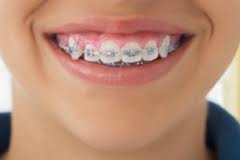 Несколько популярных вопросов о брекетах