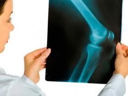 Перелом шейки бедра