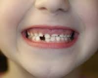 Идем к детскому стоматологу или как правильно лечить молочные зубы