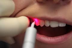 Лечение зубов лазером Лечение зубов лазером