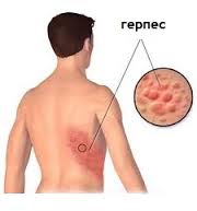 Герпес на теле Герпес на теле
