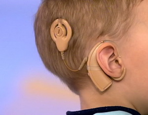 Чем помогает кохлеарная имплантация? Чем помогает кохлеарная имплантация?