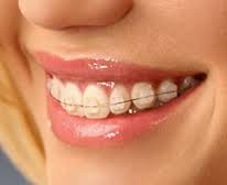 Исправление прикуса у взрослых Исправление прикуса у взрослых