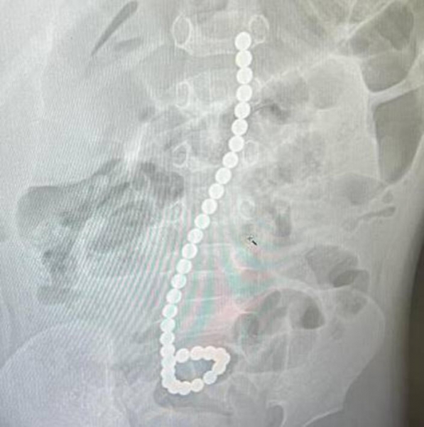 Врачи спасли полуторагодовалого ребенка, проглотившего 34 магнита